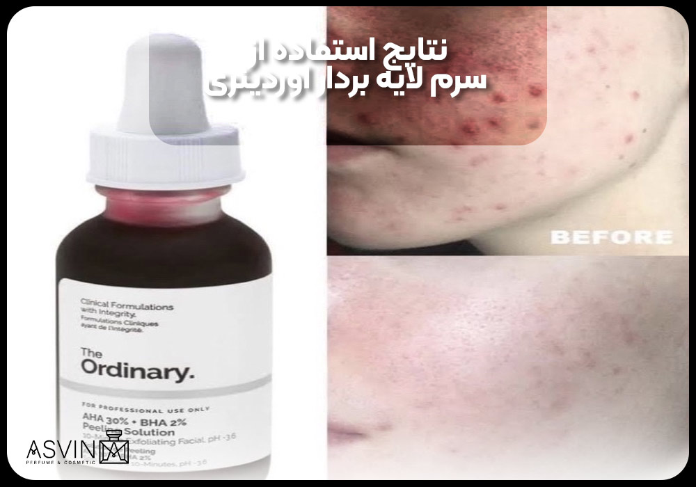 نتایج استفاده از سرم لایه بردار اوردینری (Ordinary) 30ml