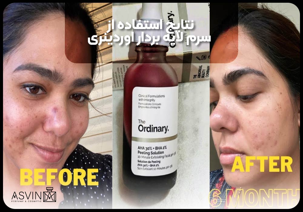 نتایج استفاده از سرم لایه بردار اوردینری (Ordinary) 30ml